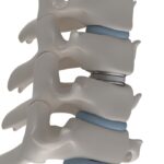 Artificial intervertebral disc prosthesis is installed between the cervical vertebrae isolated on a white 3d render image